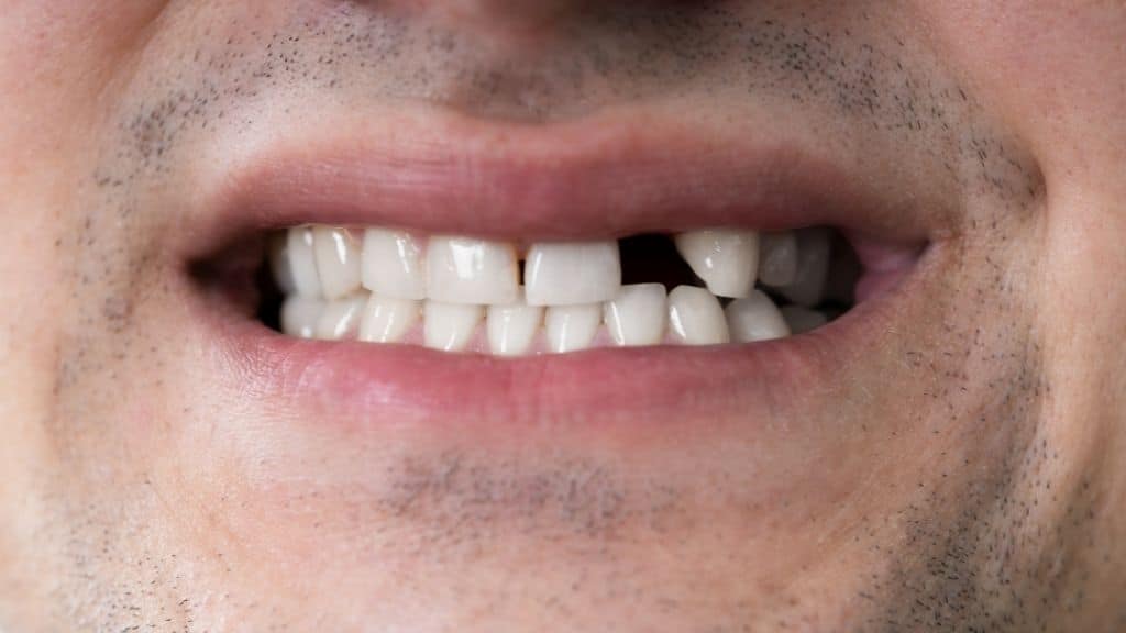 dental implants danforth toronto