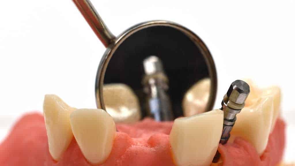 dental implants toronto