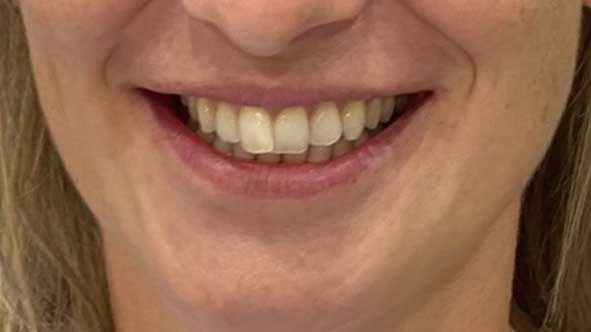 A Patient with Minor Teeth Crowding After 10 weeks of Invisalign Treatment.