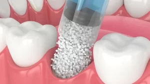Dental Implants Toronto Danforth