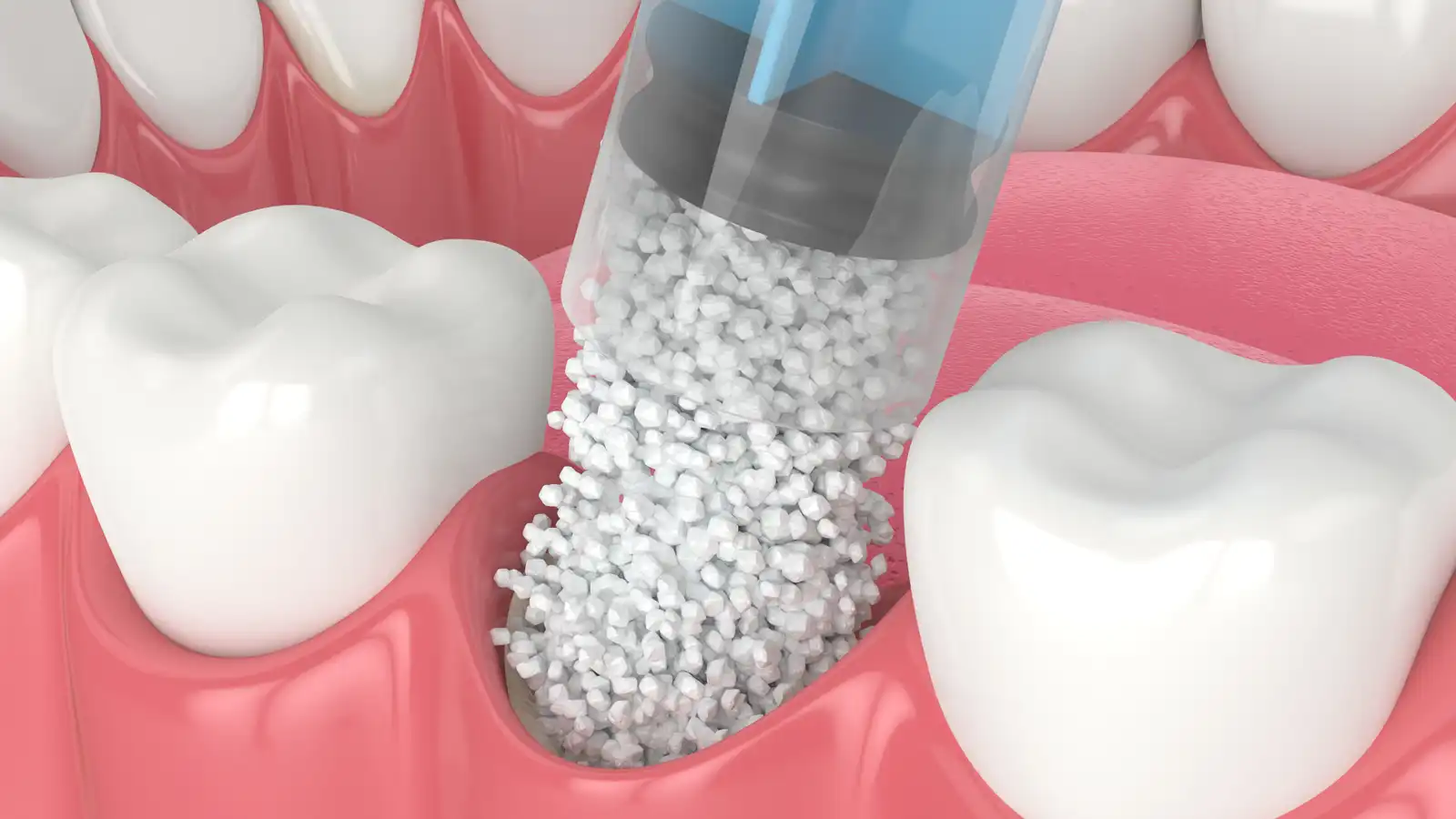 Dental Implants Toronto Danforth