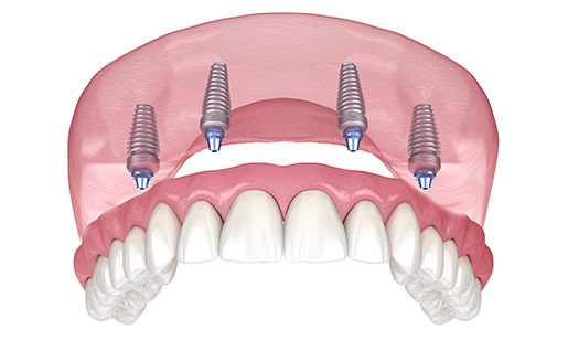 Illustration of an upper arch Fixed Implant Denture
