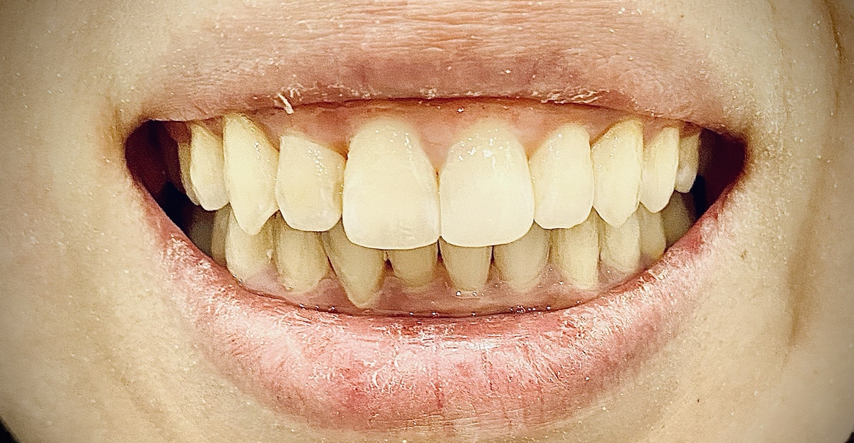 Image of an Invisalign Patient After Treatment
