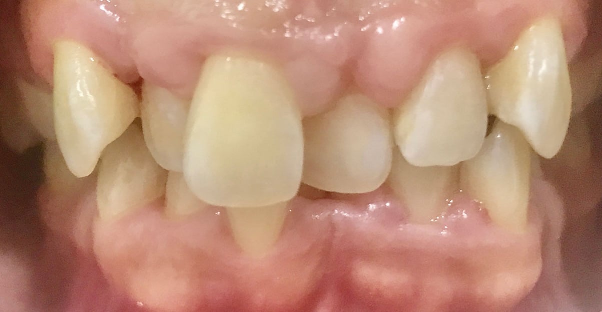 Image of an Invisalign Patient Before Treatment