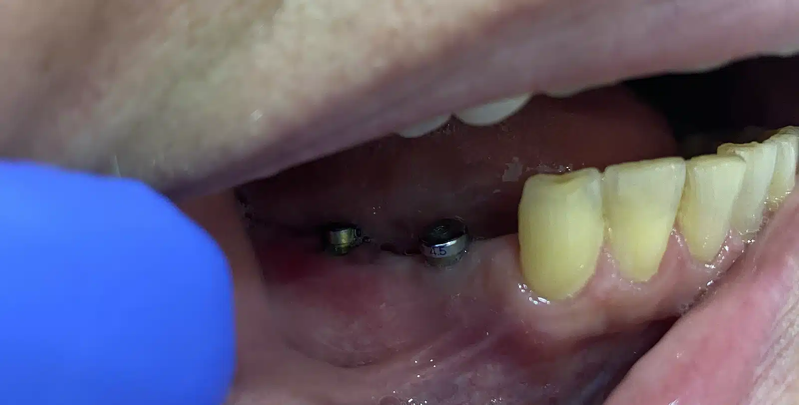 Dental Implant Treatment Toronto
