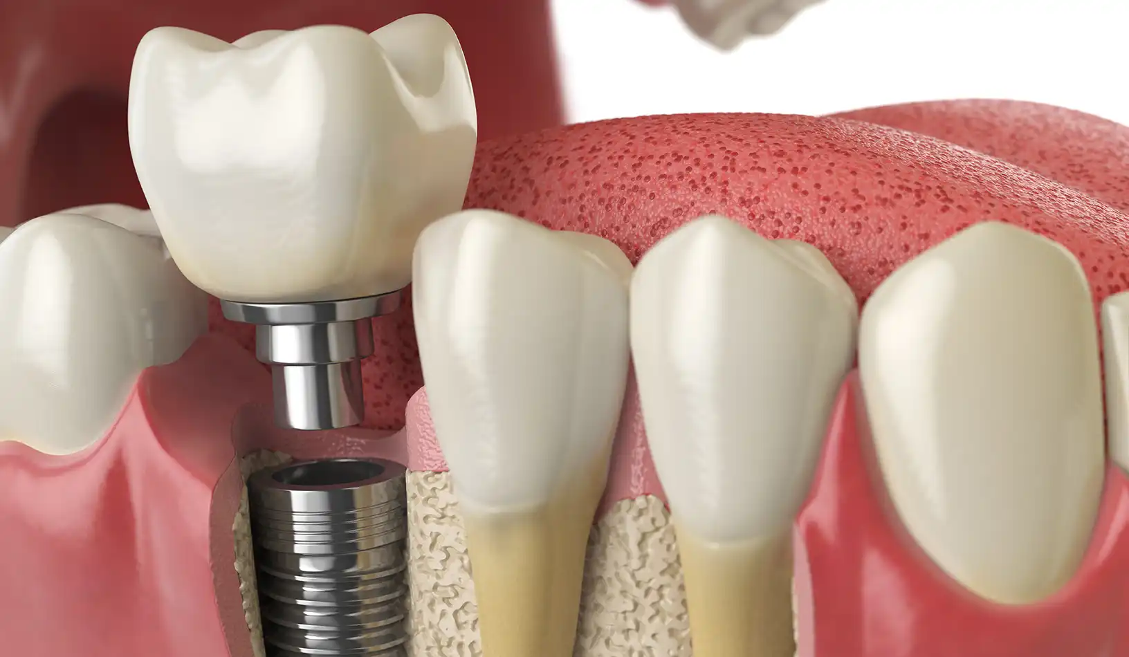 Dental Implants Danforth Toronto