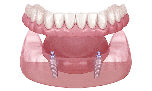 Illustration of an Implant Supported Denture from the Front View