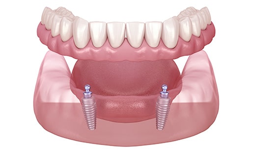 Illustration of an Implant Supported Denture from the Front View.