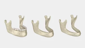 Illustration of progressive bone loss due to missing teeth.