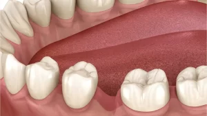 An illustration showing how teeth can shift toward a gap left by missing teeth.