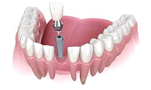 Illustration of a single-tooth dental implant from the front view.