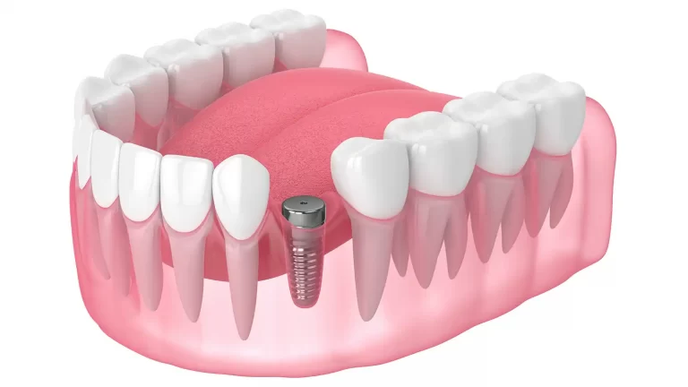 Single-tooth-implant
