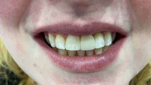 Photo Example of a Patient After Receiving Single-Tooth Dental Implant Treatment at Twogether Dental