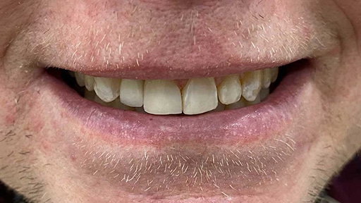 A Photo Example of a Dental Patient After Implant Surgery