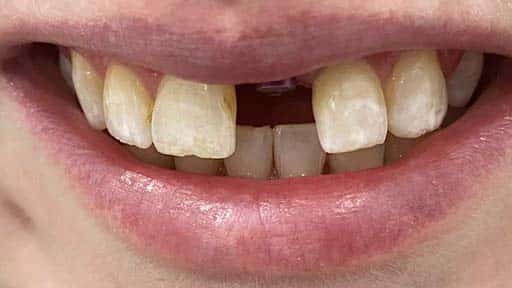 Photo Example of a Dental Patient Before Single-Tooth Dental Implant Treatment at Twogether Dental
