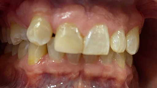 A Photo Example of a Dental Patient Before Implant Surgery.