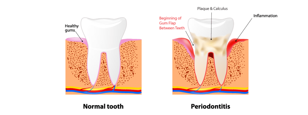 Diagram depicting gum disease and loose gum flaps between teeth
