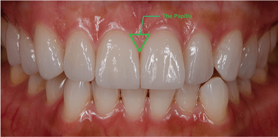 Photograph of the papilla where loose gum flaps between teeth often occur.
