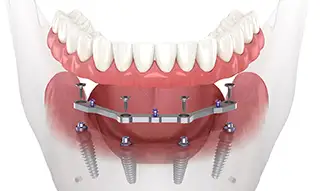 illustration of the all-on-4 denture implant solution at Twogether Dental - Danforth and East Toronto