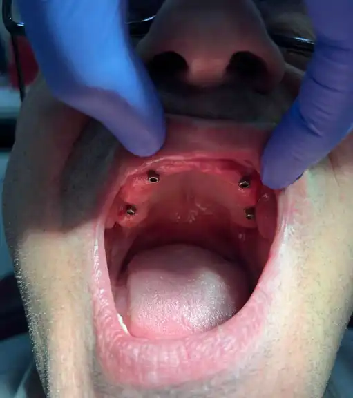 Photographic example of an all-on-4 denture implant.
