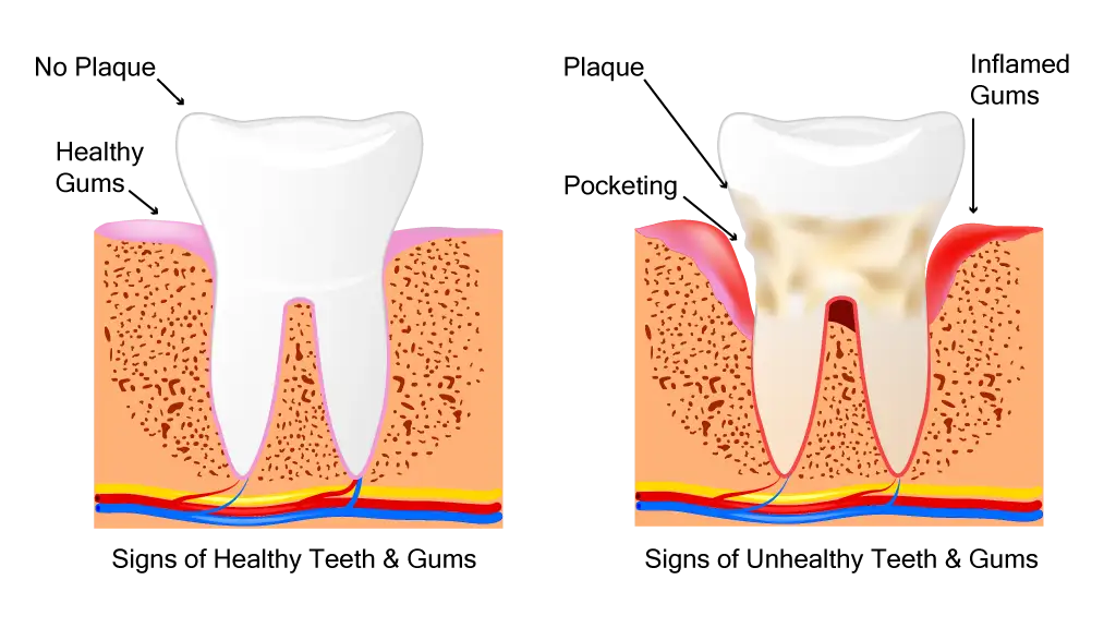 Illustration of Healthy Teeth and Gums vs Unhealthy Teeth and Gums