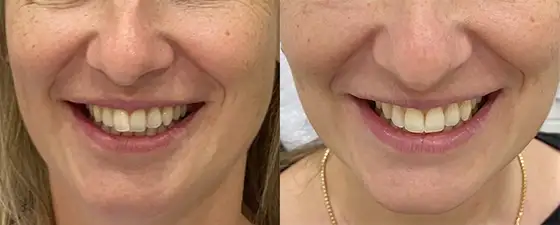 Invisalign Cost in Toronto