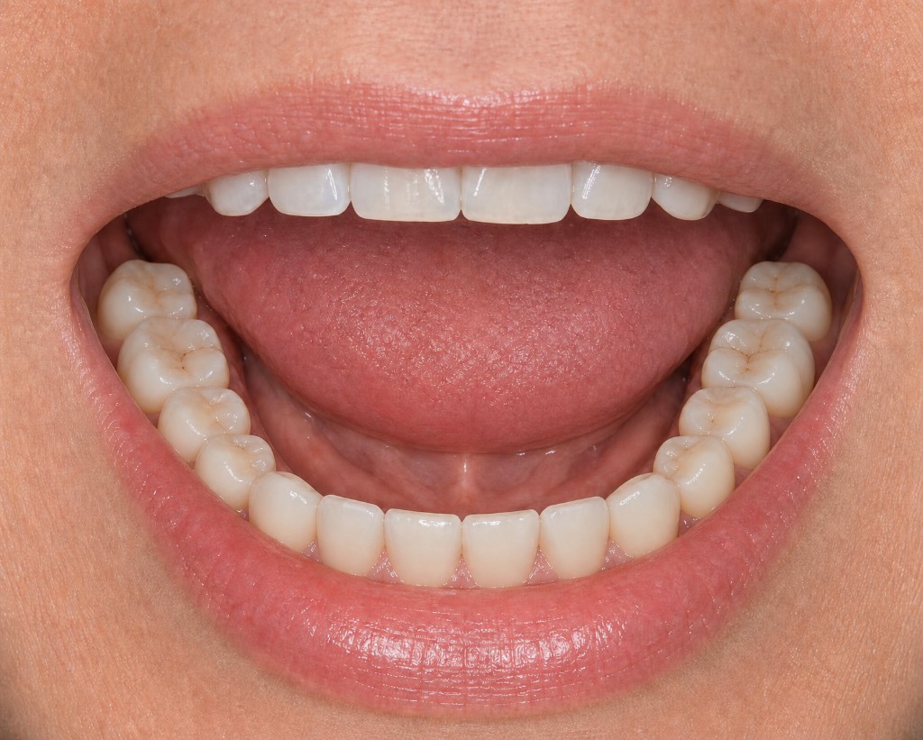 Lower teeth after tooth-coloured composite filling