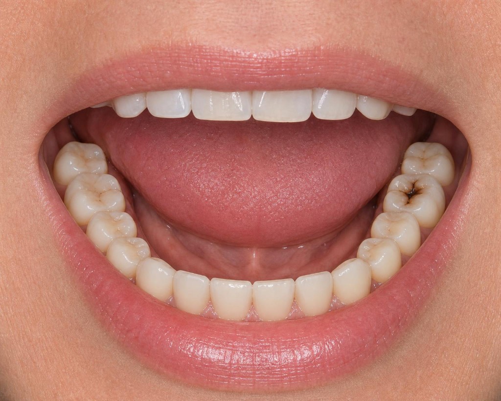 Lower teeth before composite filling, cavity visible on molar